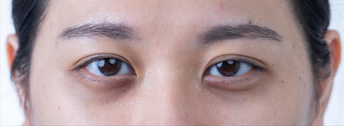 治疗黑眼圈最有效的产品,prp治疗黑眼圈需要做几次费用多少