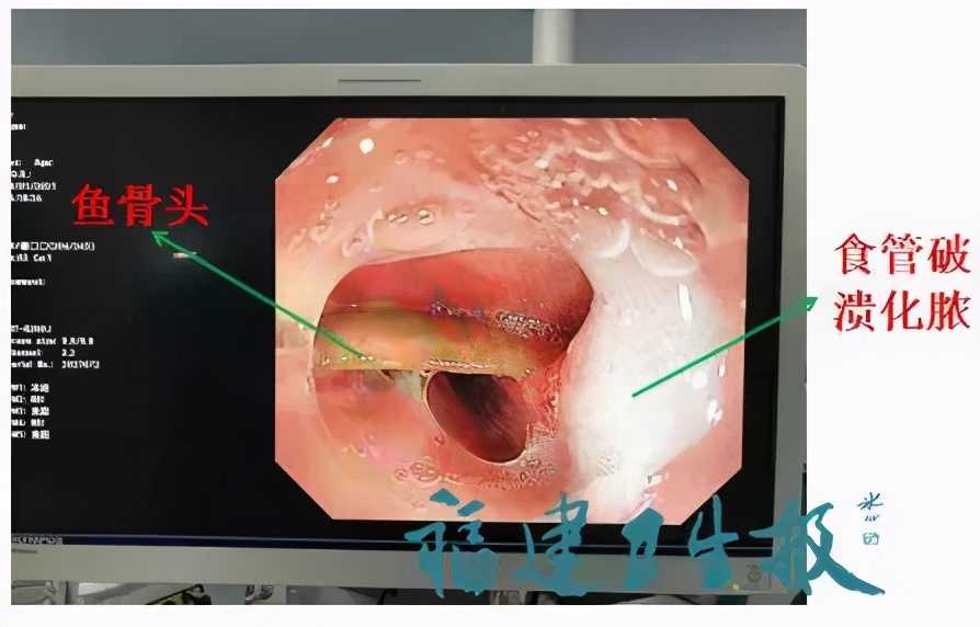 老人误吞3厘米鱼刺,误吞鱼骨最好的土方法
