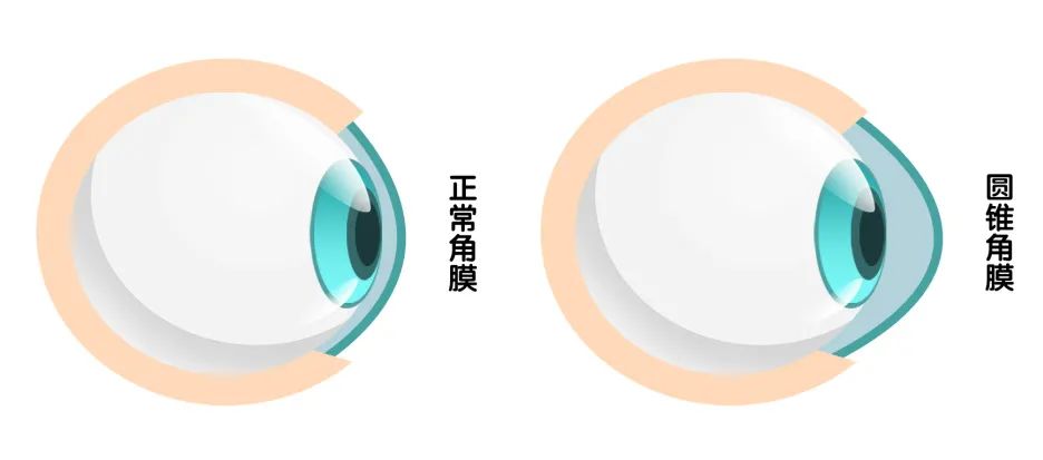 为治好近视，TA把眼睛搞瞎了