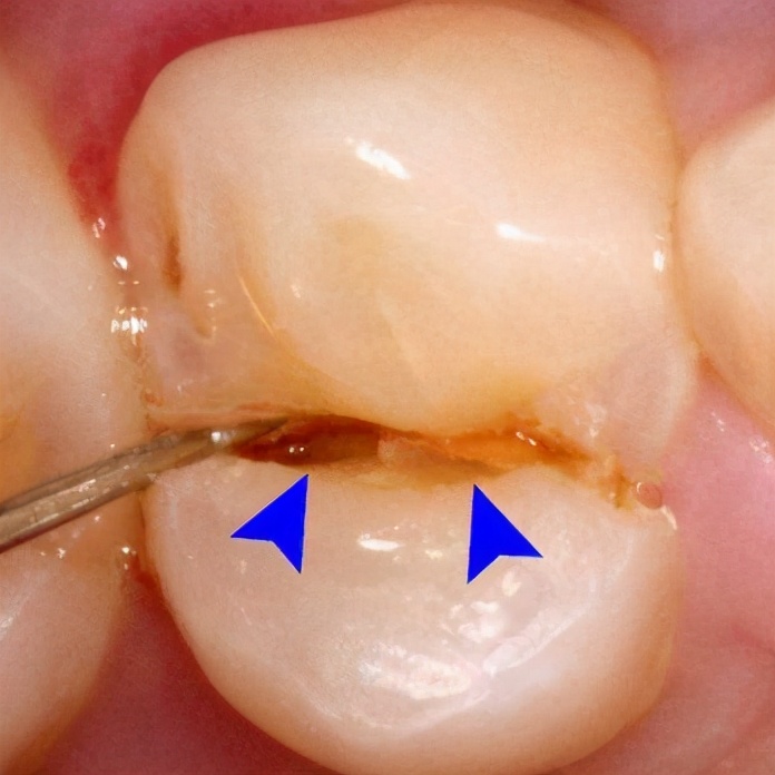 门牙根管治疗后没做牙冠牙齿劈裂,牙齿残冠一定要做根管治疗吗