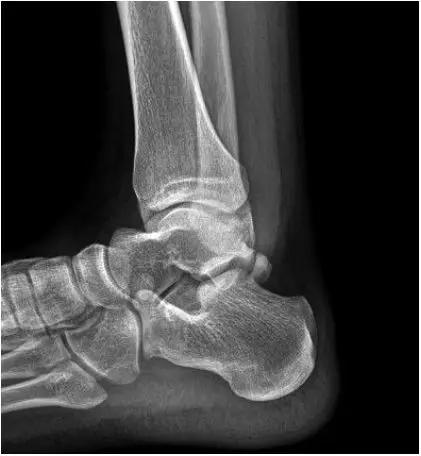 踝关节撞击症问诊,踝关节撞击综合征的x线表现