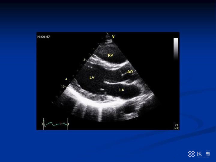 iseihealth:什么是乳腺纤维腺瘤？以及关于乳腺癌筛查的情况