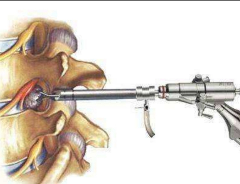 腰椎间盘4-5突出手术后易复发吗,腰椎间盘突出内固定手术复发几率