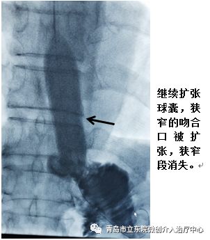 胃肠吻合术后不能经口进食,胃切除后食管空肠吻合口瘘怎么办