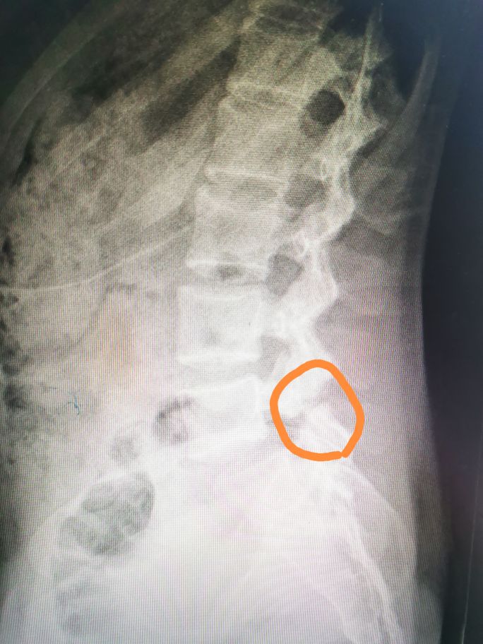 腰椎滑脱的治疗方法,腰椎滑脱手术医保多少钱