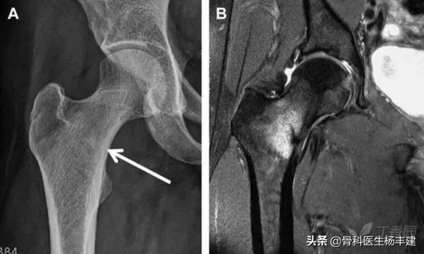 老年人骨折的注意事项九大条,您知道吗?