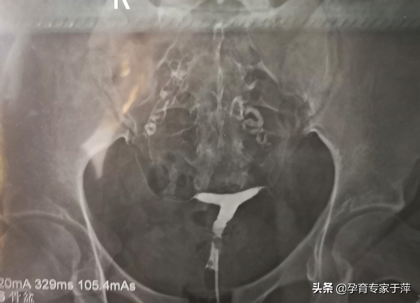 助孕专家于萍,青岛医生于萍视频