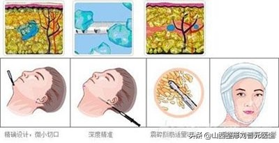 面部吸脂粘连后如何快速恢复,面部吸脂恢复视频