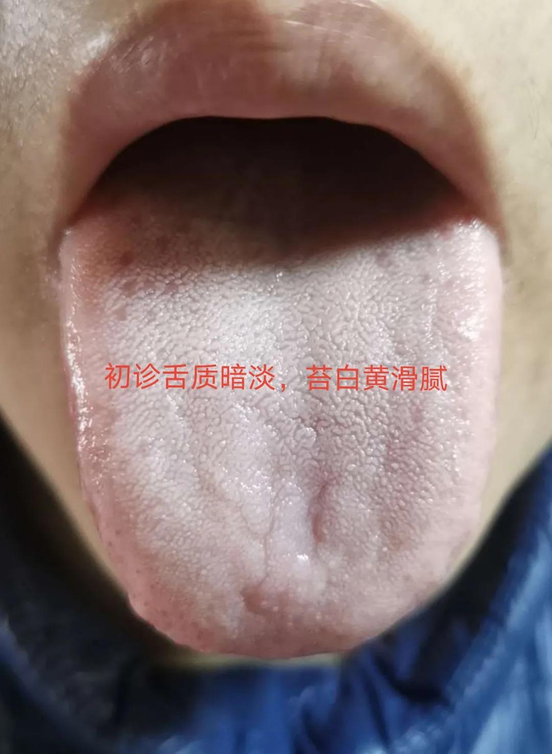 中风后遗症中医针灸治疗,中风后遗症中医治疗一例