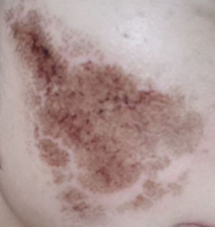 点阵激光能把伤疤完全修复吗,激光点阵可以修复到多少程度