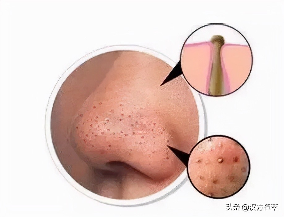 鼻子为什么那么容易长黑头,为什么鼻子最容易长黑头