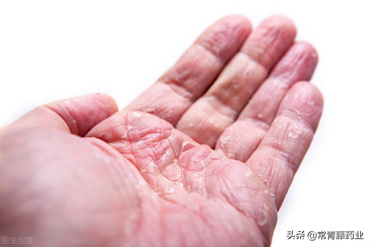 银屑病外用特效药伤肝不,银屑病用什么药见效快还没副作用