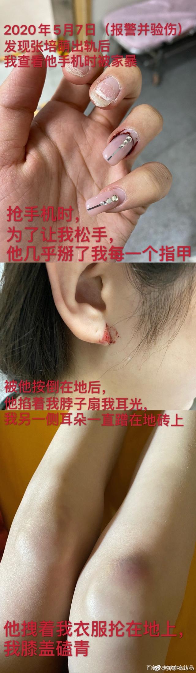 美女主播爆运动员丈夫孕期家暴还被拔指甲，男方甩锅激素太无语