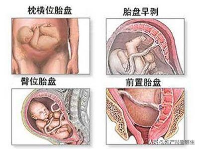 揭开产房神秘面纱,原来剖腹产有多可怕