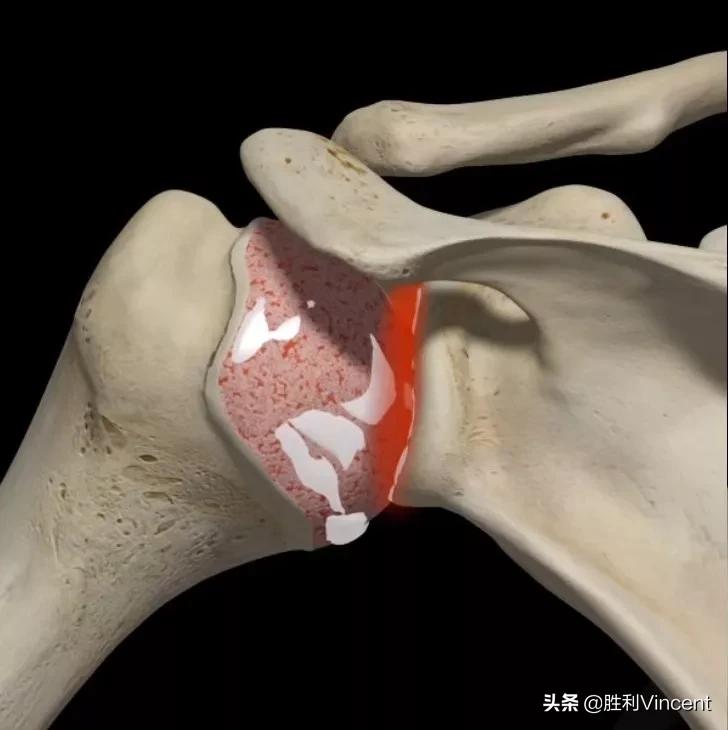 常见踝关节运动损伤的类型和原因,运动解剖踝关节的运动方式讲解