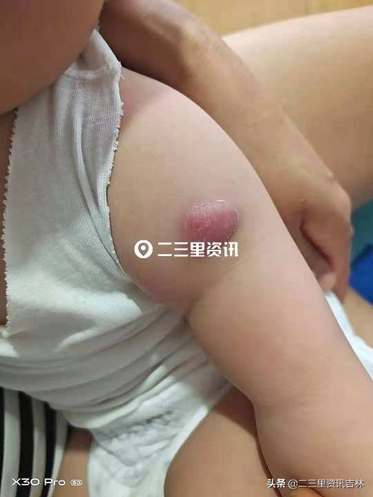 小孩接种卡介苗一年半后红肿痒,打卡介苗50天后化脓红肿怎么护理