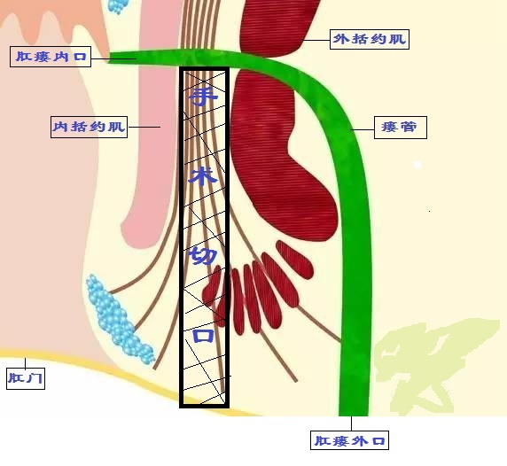 肛瘘lift手术天津哪有医院使用,北京哪家医院能做lift肛瘘手术