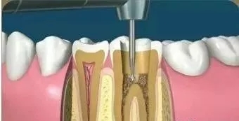看牙贵早已成为无数人心中的痛点,看牙那么贵为什么不享受医保