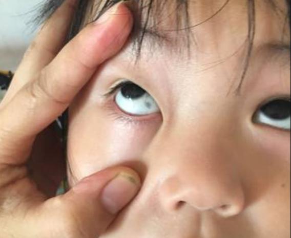 眼白里的小黑斑可以去除吗,宝宝眼白上有小红斑是什么原因