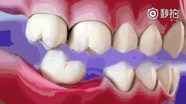 牙齿缺失后不镶牙有啥危害,牙齿缺失后不补有什么危害