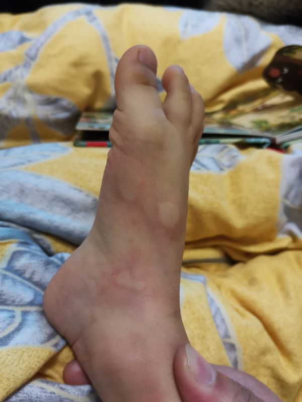 宝宝身上起好多疙瘩，跟蚊子咬的差不多，很痒，怎么办亲身经历