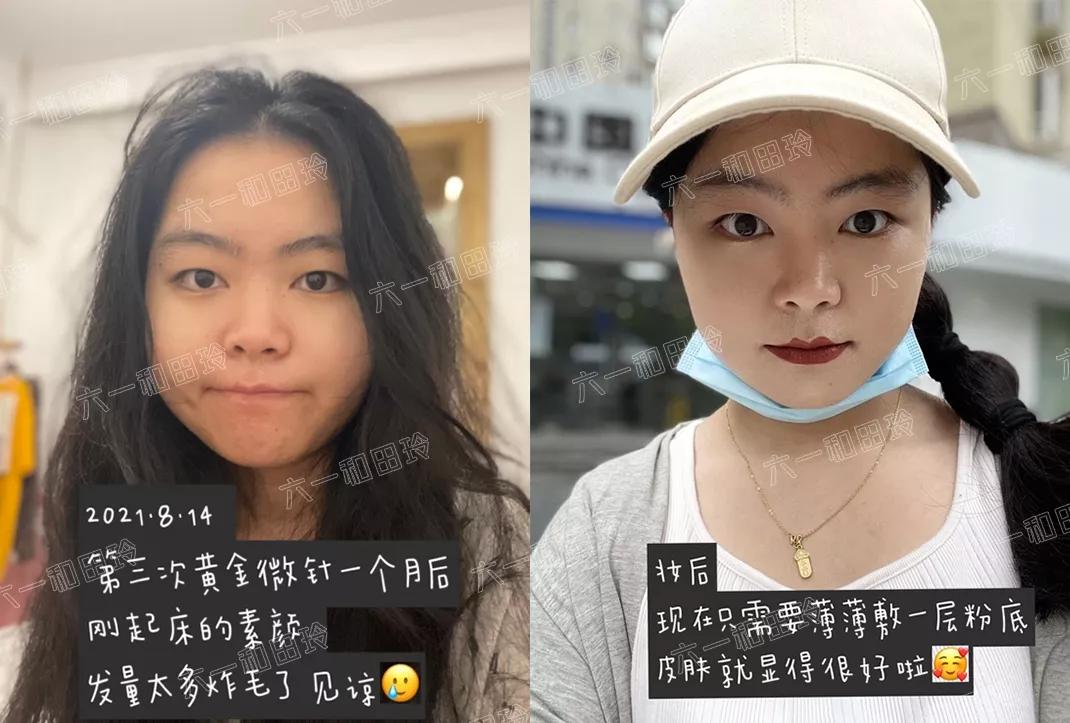 3250个文字很长，希望有痘坑的你看下去