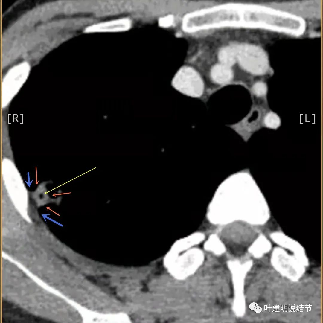 临床诊断孤立性肺结节,空洞型结节一般是什么性质