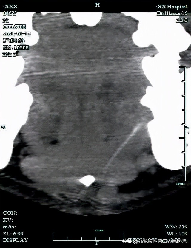 下巴牙齿根脓肿,下巴囊肿压迫牙齿