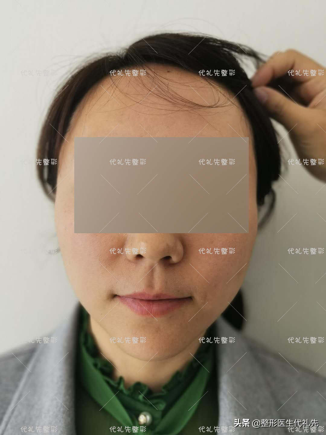 拉皮手术能彻底去除法令纹吗,拉皮术后法令纹木偶纹还在怎么办