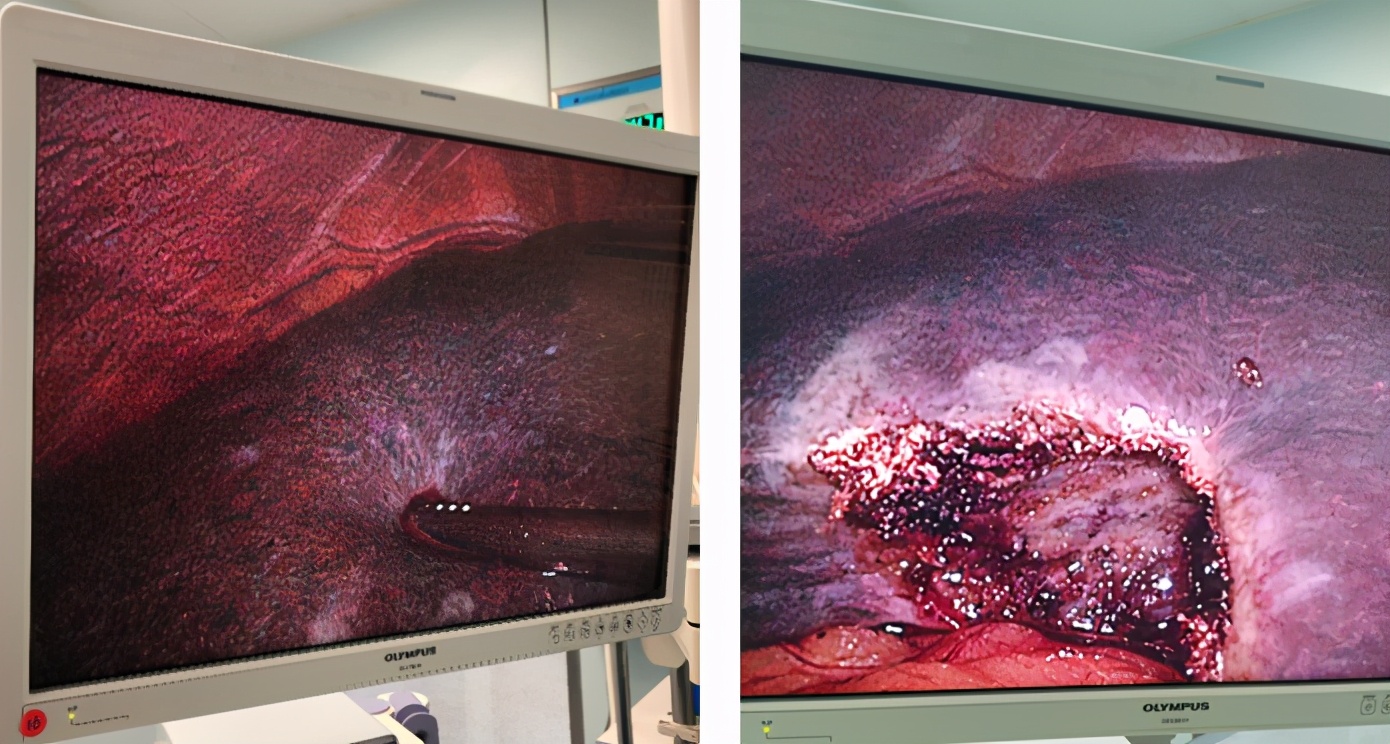 dubinjohnson综合征无药可治,lc手术并发症