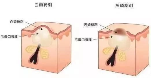 教你快速消灭脸上闭口型痘痘,实用的祛痘痘方法