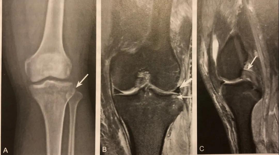 膝关节常见损伤的检查方法,膝关节损伤病例图片