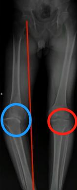 关节炎与痛风性关节炎有什么区别,关于痛风的30个辟谣的问题