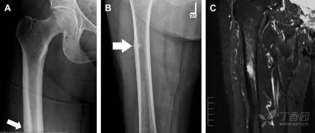 放射科夜班病例大全,放射科容易漏诊的骨折