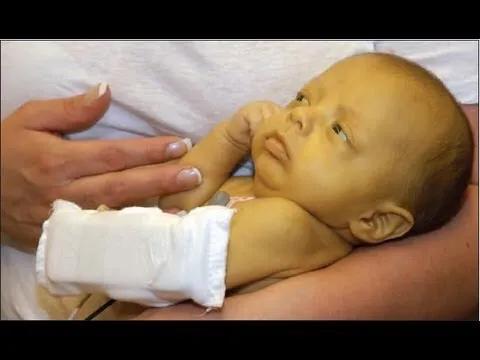 新生儿高胆红素血症是什么黄疸,新生儿高胆红素血症是病理黄疸吗