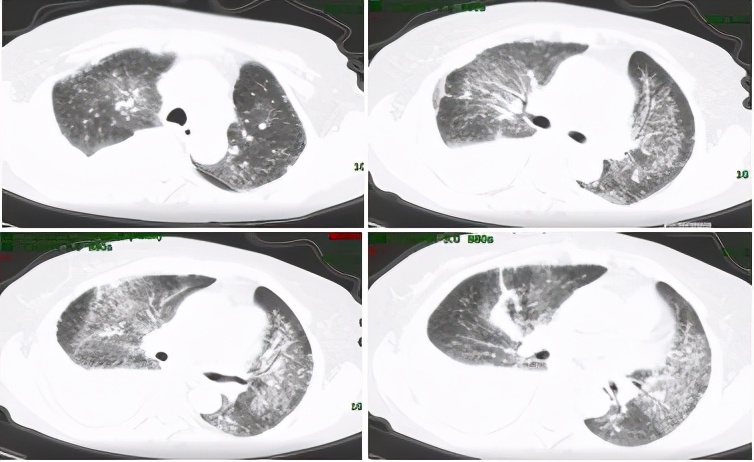 无明显诱因咳嗽、呼吸困难，大量胸腔积液，竟与妇科肿瘤有关？