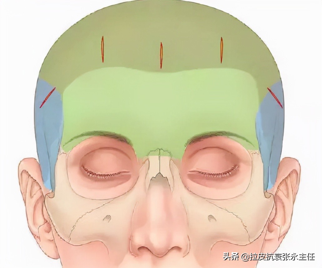 内窥镜小切口面部除皱术多少钱,微创内窥镜除皱副作用