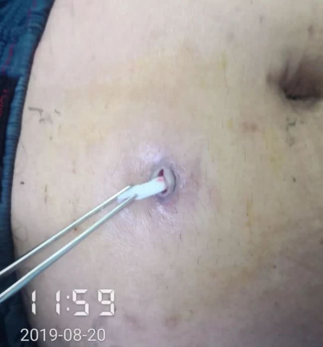 阑尾炎形成窦道的原因,阑尾炎一孔微创手术全过程