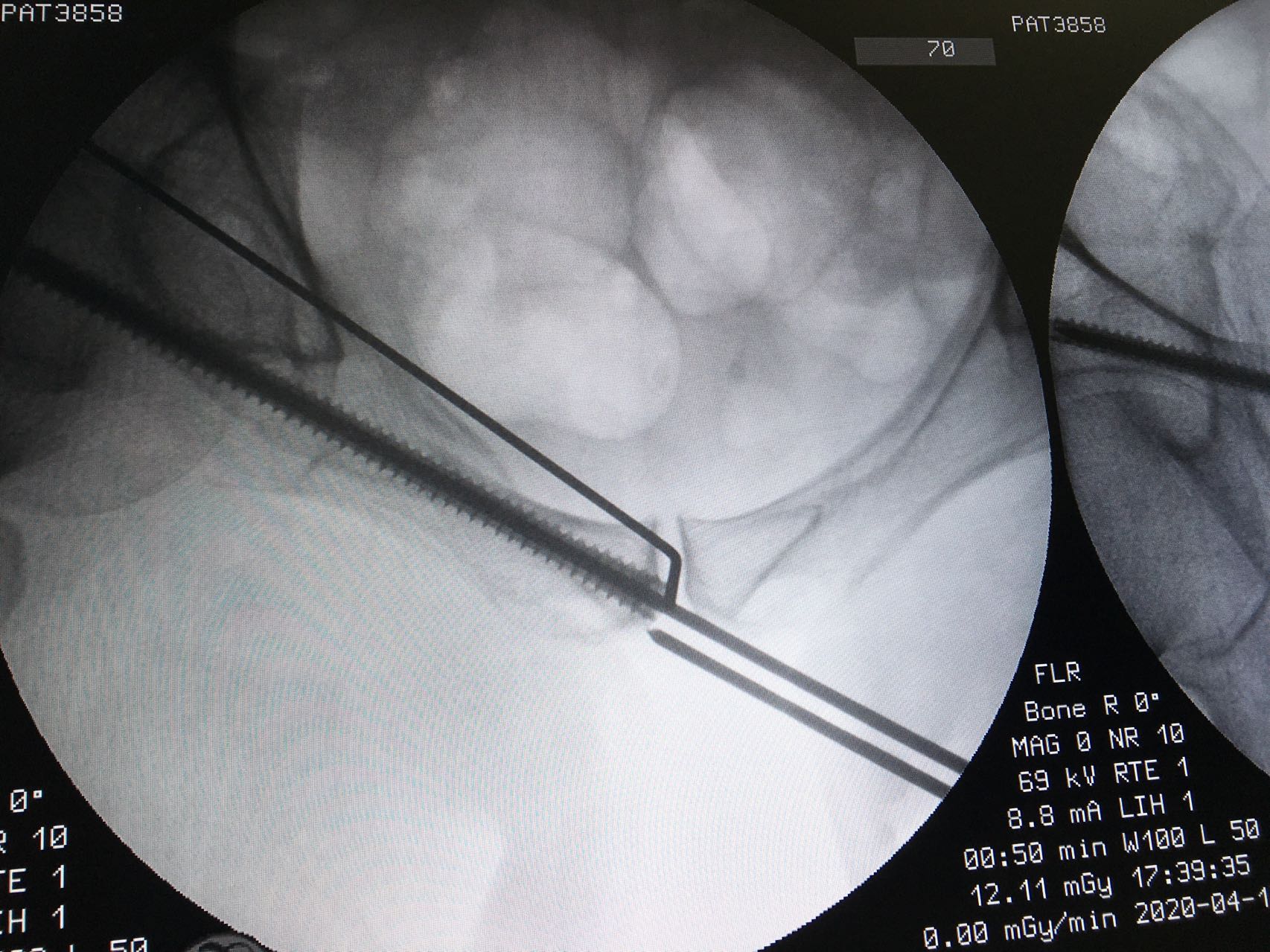 一名骨科医生股骨骨折经历,骨科朱医生