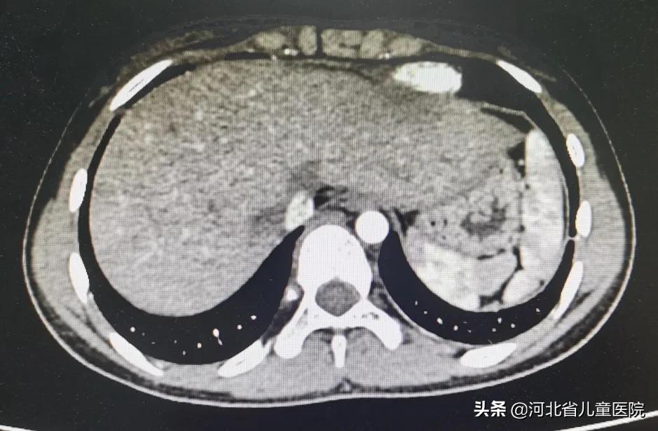 河北省儿童介入科,布加氏综合征介入手术