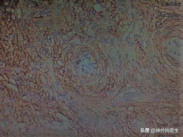 脑膜瘤是什么原因引起的啊,脑膜瘤手术治疗全部大概多少钱