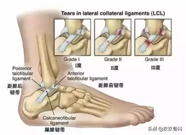 崴脚后遗症的三步恢复法,很多人的脚都崴伤