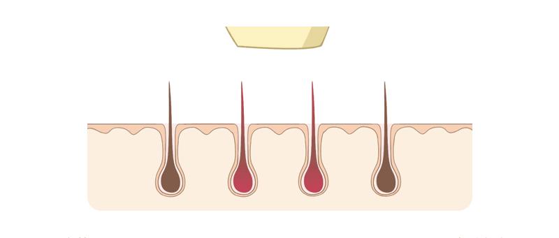 激光脱毛能永久吗脸上,激光脱毛能永久吗知乎