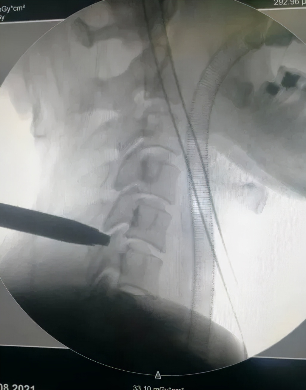 成功开展“钥匙孔”技术治疗颈椎病