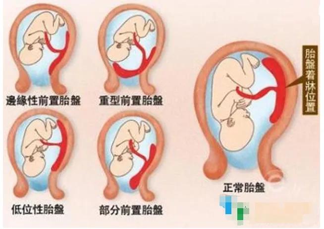 孕产｜发现“前置胎盘”怎么办？