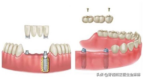 后牙做烤瓷牙冠还是全瓷牙冠,后槽牙做全瓷牙冠会不会掉