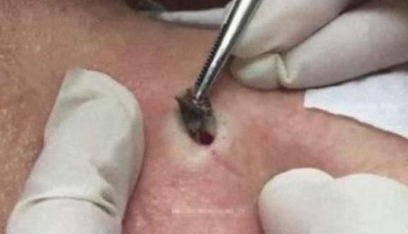 女人背后长了好多红色的痣,女子背上长的老黑痣最近痛痒