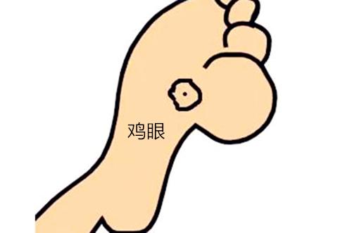 千万不要用鸡眼膏治疗跖疣,鸡眼跖疣到底怎么分辨