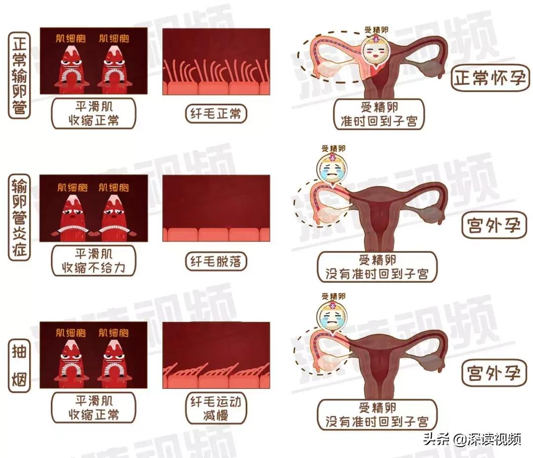 宫外孕有哪些习惯,怎样不容易宫外孕