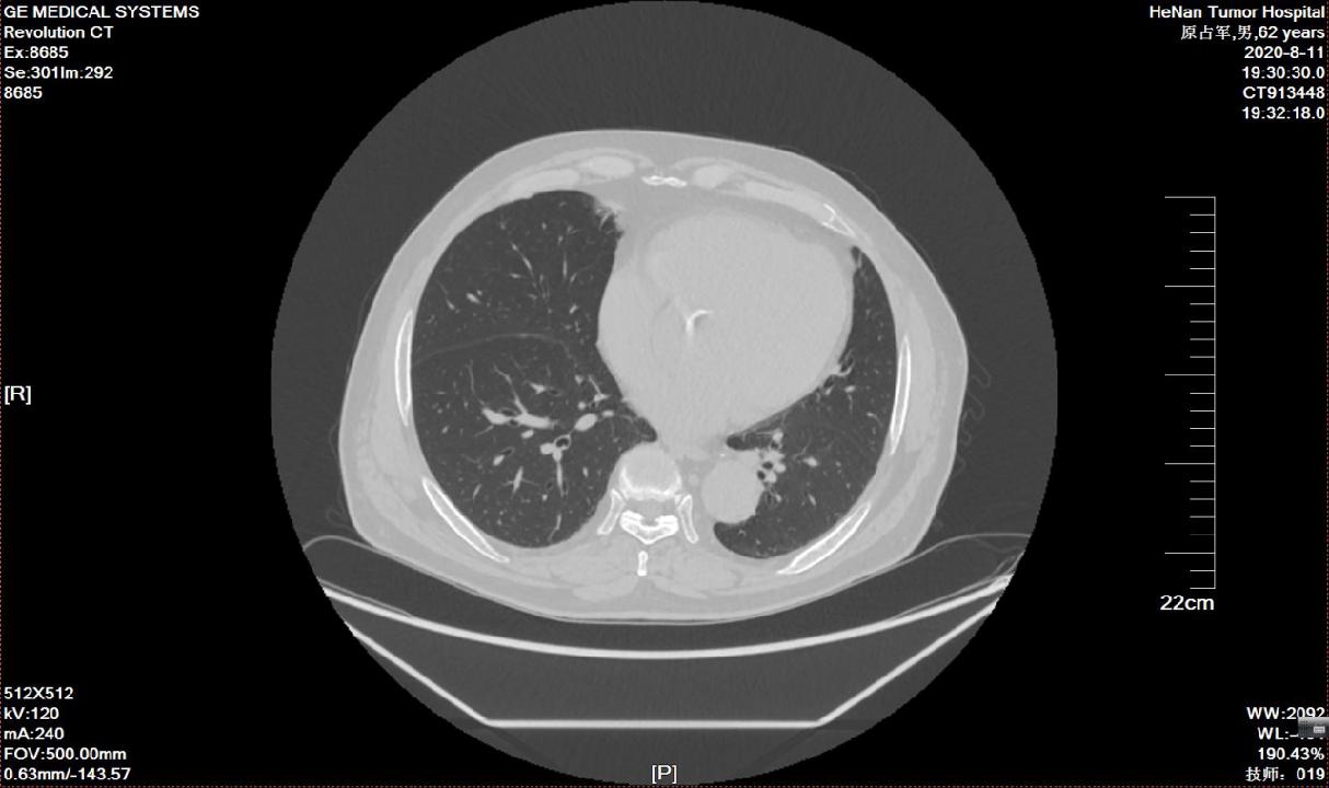 查出来“甲状腺癌”，还能活多久？最详细的治疗介绍如下